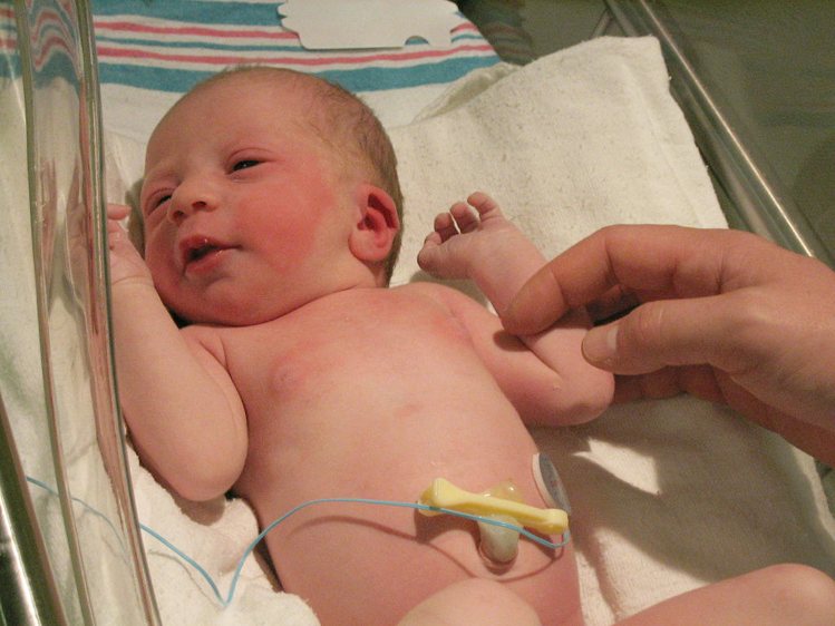 शिशु के गर्भनाल की सही देखभाल taking care of baby Umbilical cord